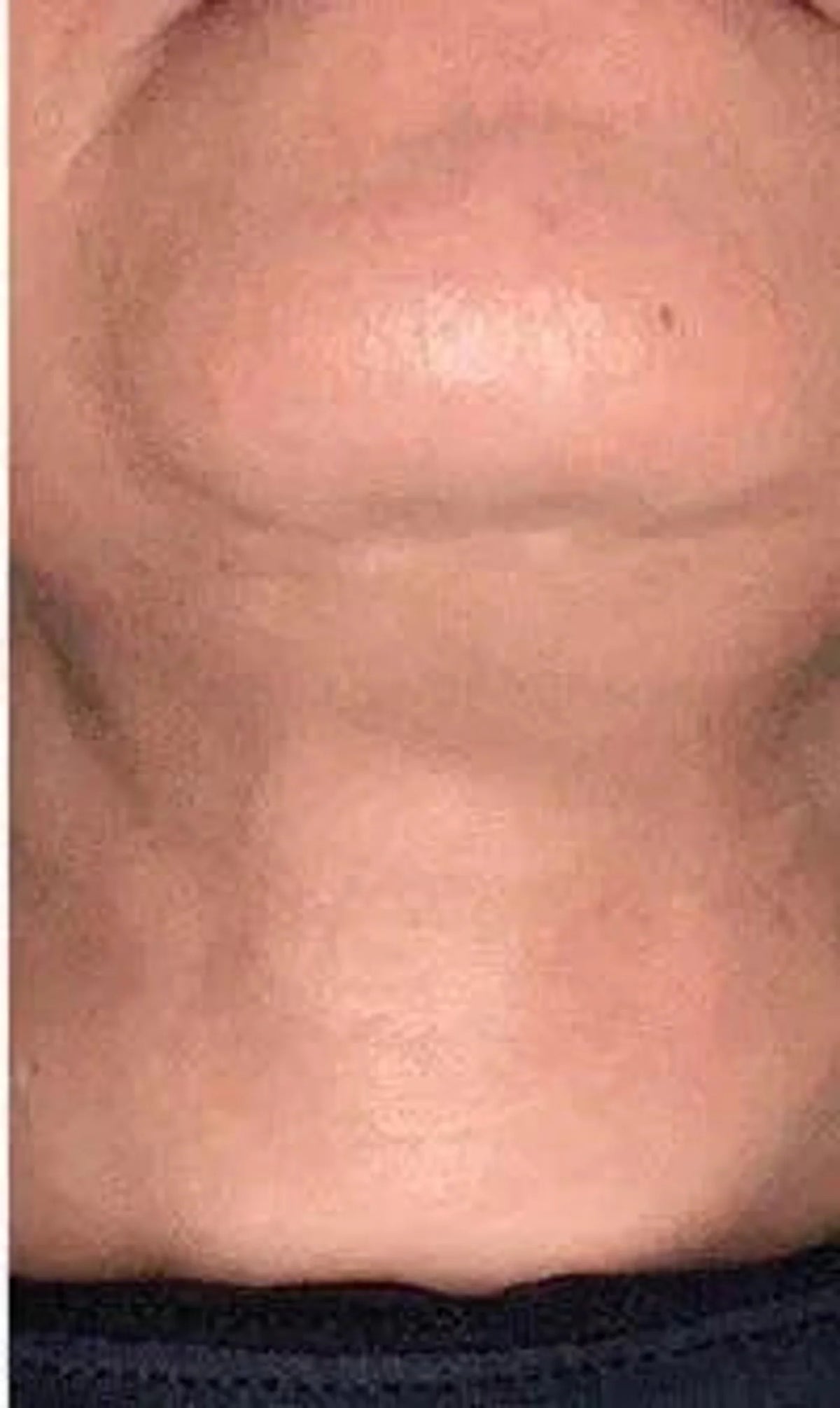 After view in the supplied torso-area comparison