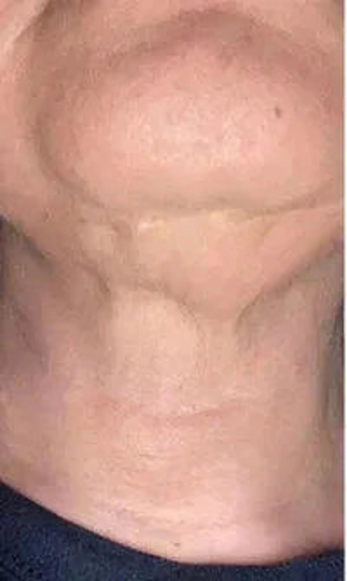 Before view in the supplied torso-area comparison